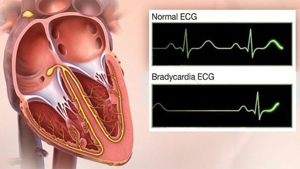 Bradycardie dans l'hypertension
